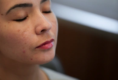 GALERIA 2 - Melasma