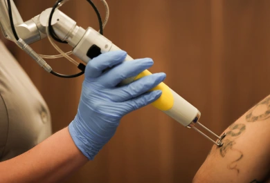 GALERIA 1 - Remoção de Tatuagem