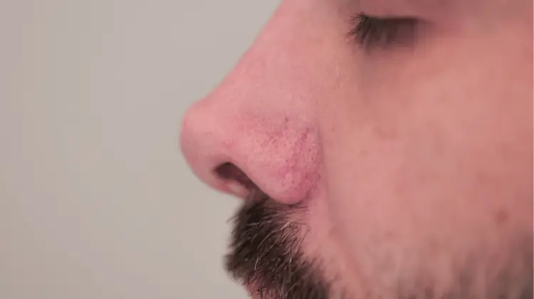 Varizes de Face