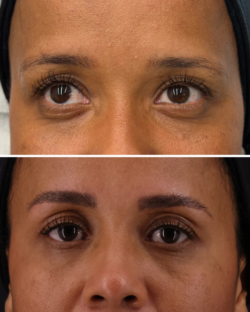 Implante de sobrancelha: Antes e depois