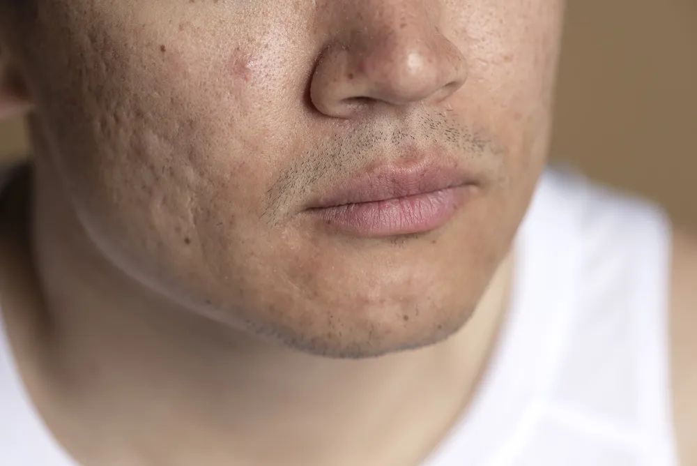 Close da pele com cicatriz de acne na bochecha e no queixo