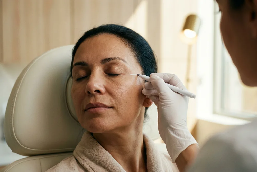 Médica marcando a têmpora da paciente para aplicação de microfat e nanofat