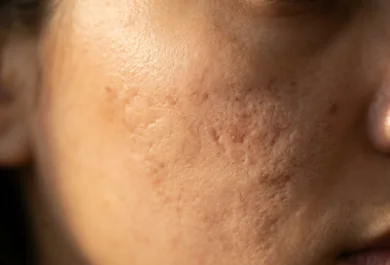 Pele com marcas e cicatrizes de acne, uma das indicações do Biolifting Regenerativo